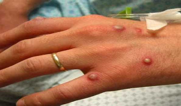 Macao reports first monkeypox case